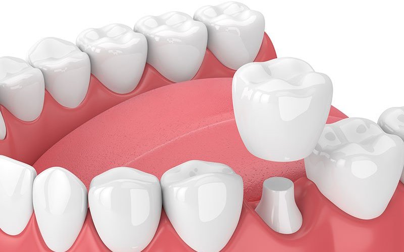 All You Wanted To Know About Dental Crowns