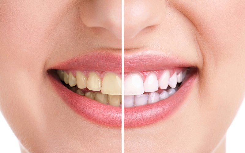 Find the Right and Reliable Teeth Whitening Bedfordshire